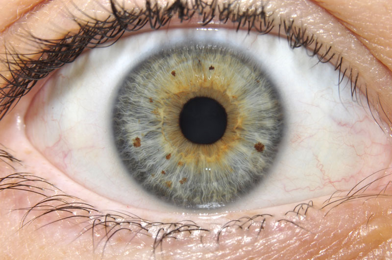 2. Auge - Iridologie (Augendiagnose/Irisdiagnose)